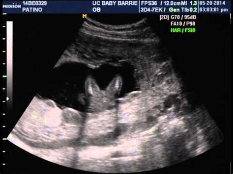 17 week ultrasound gender girl or boy? - YouTube