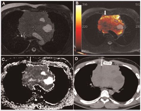 A 35-year-old man with a large mass in the anterior mediastinum. The... | Download Scientific ...