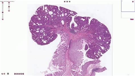 Tubular Adenoma Histology