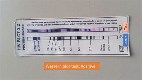 Western blot test: Introduction, Principle, Procedure and Result ...