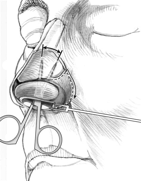 Facial degloving approach to the midface - Operative Techniques in Otolaryngology-Head and Neck ...