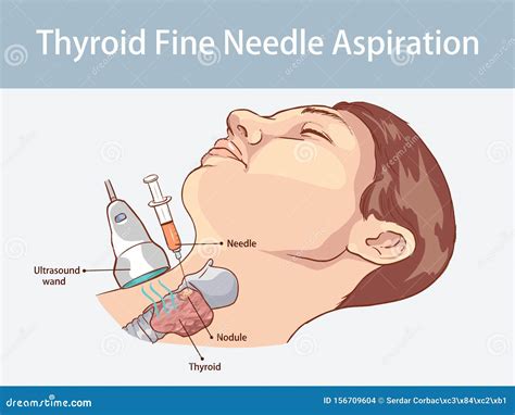 Fine Needle Aspiration of Thyroid Nodules Stock Vector - Illustration of thyroid, nodules: 156709604