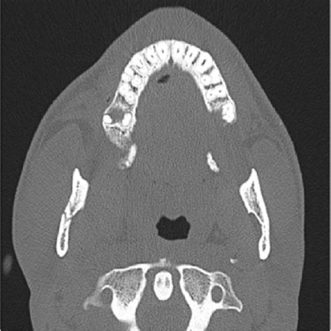 3D sagittal view/ORIF of the mandible fracture and close reduction of... | Download Scientific ...