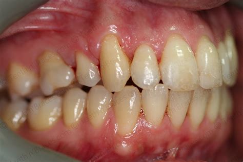 Case 8: Protruded and Irregular Teeth | Teeth N Braces