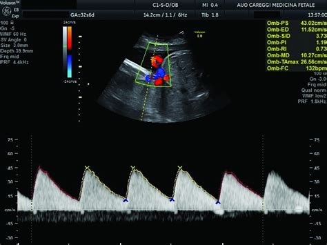 Application of Umbilical Artery Classification in Complicated ...