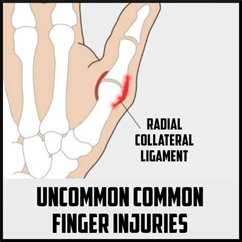 The Uncommon Common Finger Injuries - Sports Medicine Review