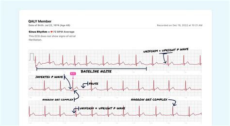 Premature Junctional Contraction P Wave