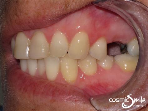 Snap on Smile - Before and After - Cosmic Smile Dental