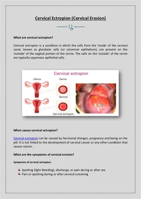 What are Cervical Ectropion?