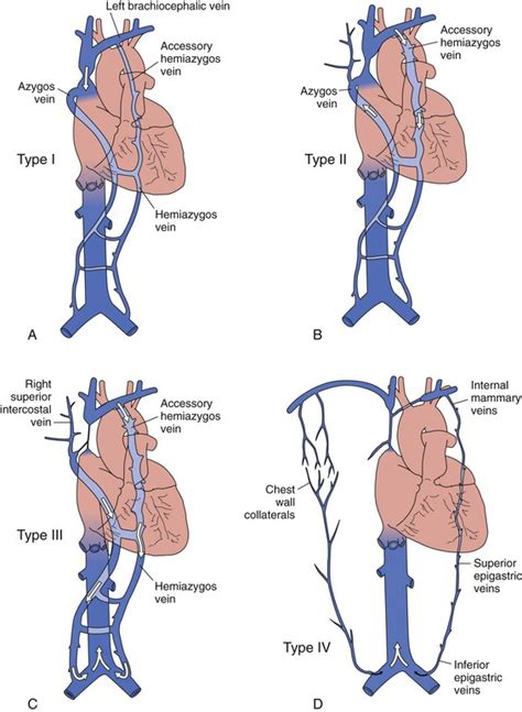 Inferior Vena Cava Syndrome