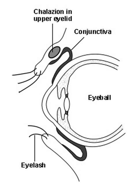 Meibomian Cyst - Pictures, Causes, Treatment (Removal and Surgery)