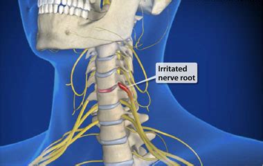 Cervical Radiculopathy Rehab Exercises - [P]rehab