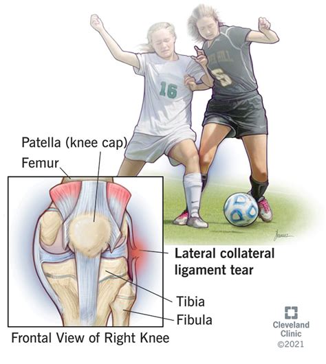 Lateral Collateral Ligament (LCL)Tear: What Is It, Causes & Treatment