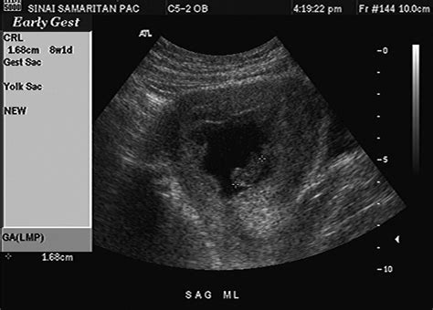 A Molar Pregnancy Detected by Following β-Human Chorionic Gonadotropin ...