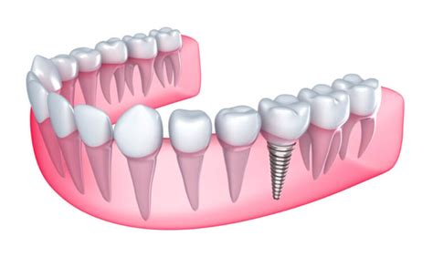 Single Tooth Implant | Your Trustworthy Oral Surgery Specialist in ...