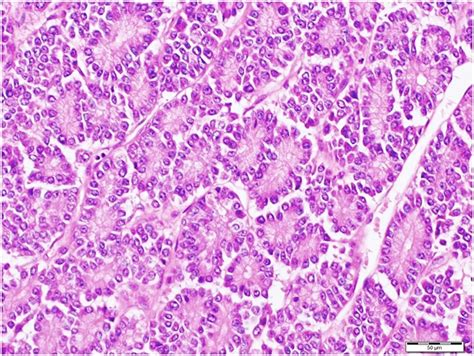 Pathology diagnosis of pancreatic neuroendocrine tumors - Kasajima - 2015 - Journal of Hepato ...