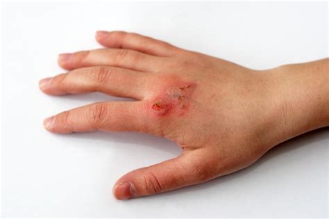 Burn Treatment | Automobile Accident Treatment