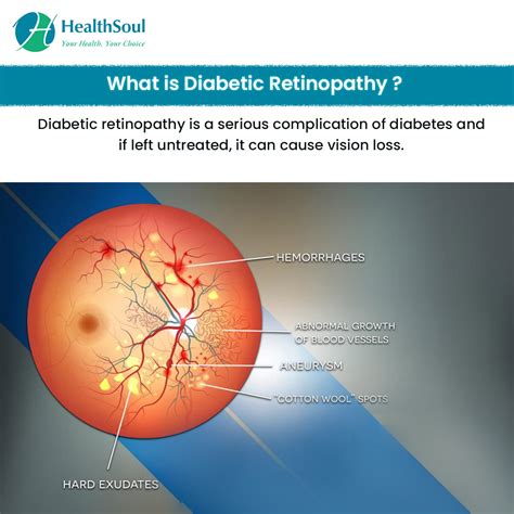 Diabetic Retinopathy: Symptoms, Diagnosis, and Treatment – Healthsoul