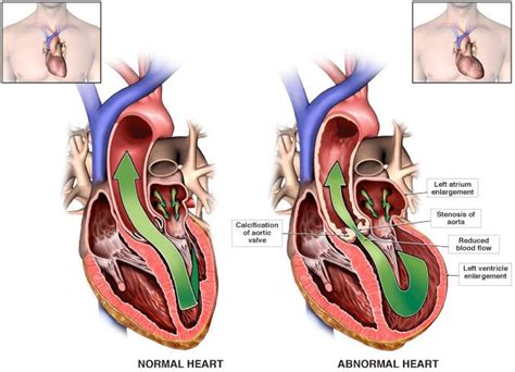 Aortic Stenosis