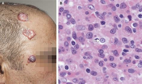 Malakoplakia, definition, causes, symptoms, diagnosis & treatment