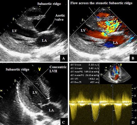 A case with discrete fibromuscular subaortic stenosis: evaluation by ...