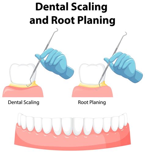 Dental Scaling Planing