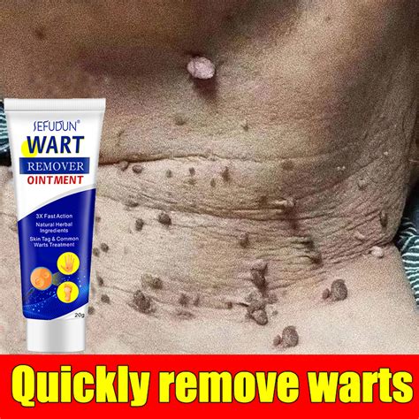 Warts Remover Original Cream Warts Magic Remover Ointment Wart Removal Treatment Cream Skin ...