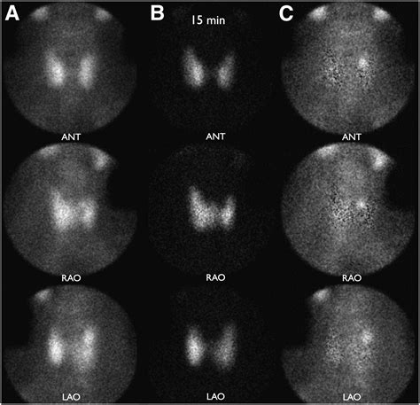 Parathyroid Imaging: The Importance of Dual-Radiopharmaceutical ...