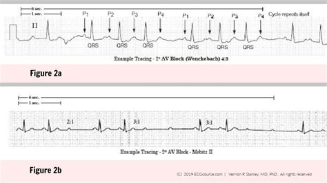 Rhythms Review: Is this Second Degree AV Block 2:1 Mobitz I or Mobitz II? - Dr. Stanley's ...