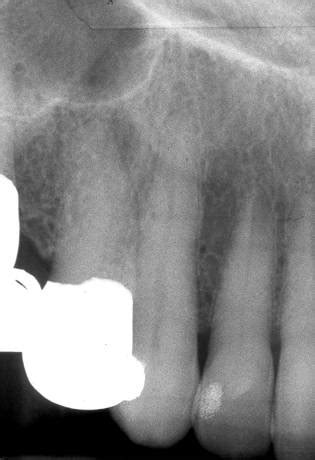 maxillary-canine2 - Denteach