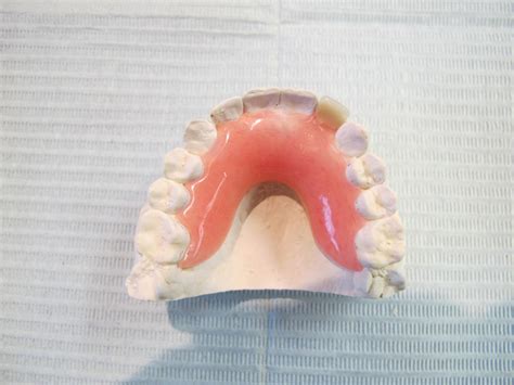 Acrylic Partial - Baker Lanoue Denture Clinic