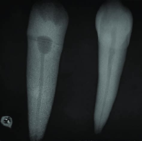 Maxillary canine radiograph. | Download Scientific Diagram