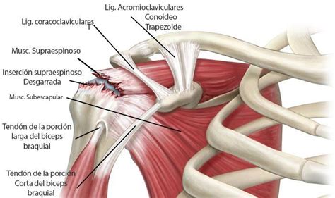 Desgarro o rotura del manguito rotador del hombro. Causas, síntomas y tratamiento ...
