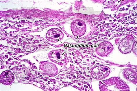 Balantidium coli. Balantidiasis. 250X - Protozoa (Protozoa ...