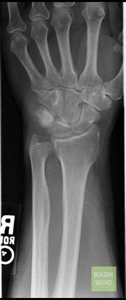 Triquetral fracture - wikidoc