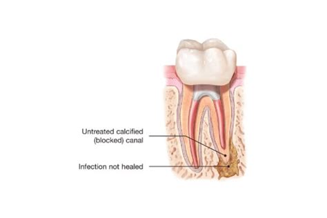 Root Canal Infection Symptoms That You Shouldn't Ignore