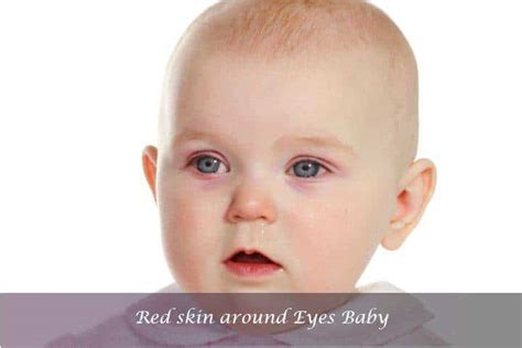 Why baby have red skin around eyes