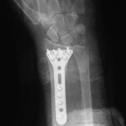 Distal Radius ORIF 25607 | eORIF