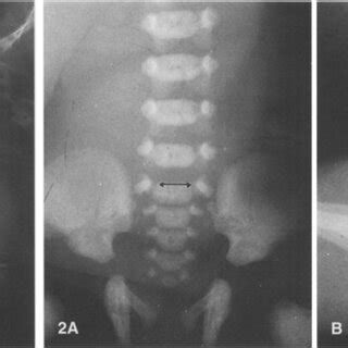 T2-weighted MRI showing deposition of haemosiderin manifesting as a low... | Download Scientific ...