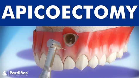 Apicoectomy - Treatment of root canal infection © - YouTube