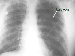 Apical Pleural Thickening Chest X Ray