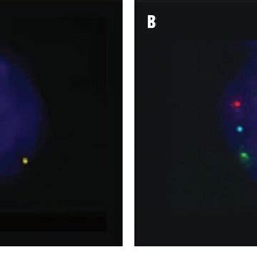 FISH images showing a euploid cell in a benign peritoneal effusion case... | Download Scientific ...