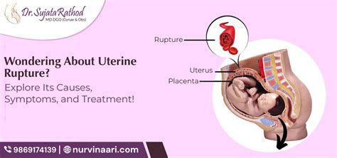 Uterine Rupture Unveiled: Causes, Symptoms, Treatment with Lady ...