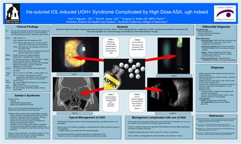 (PDF) Uveitis-Glaucoma-Hyphema (UGH) syndrome exacerbated by high-dose ...