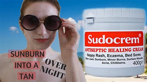 THE SUDOCREM EXPERIMENT || How to get rid of sunburn FAST || also ...