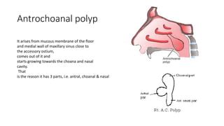 Nasal polypi otorhinolaryngology types etiology management ent ppt | PPT