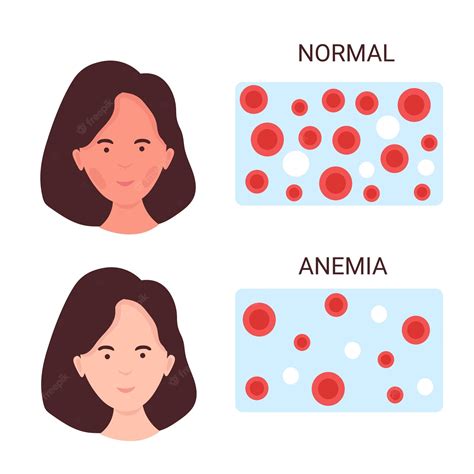 Premium Vector | Pale woman suffering from anemia Vector medical poster ...