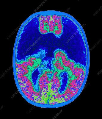 Coloured MRI brain scan showing holoprosencephaly - Stock Image - M170 ...