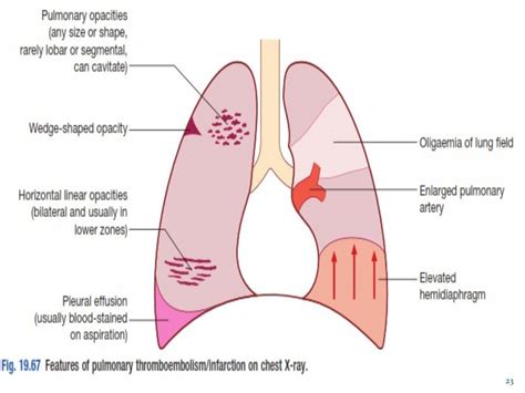 L9 pulmonary embolism