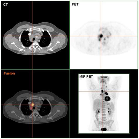 PET/CT scan of a hodgkin lymphoma, histologically validated. - DocCheck